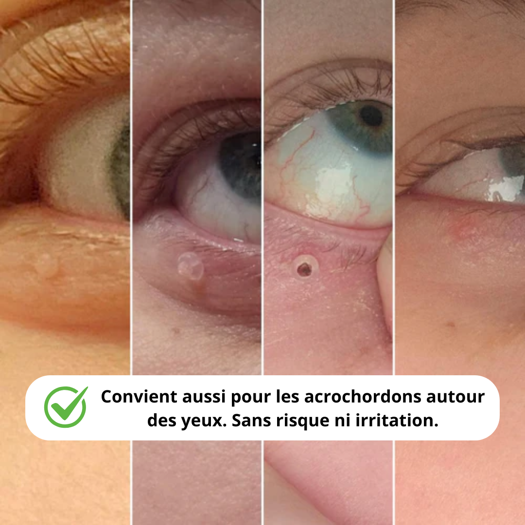 Kit Peau Lisse - Anti-Accrochordons