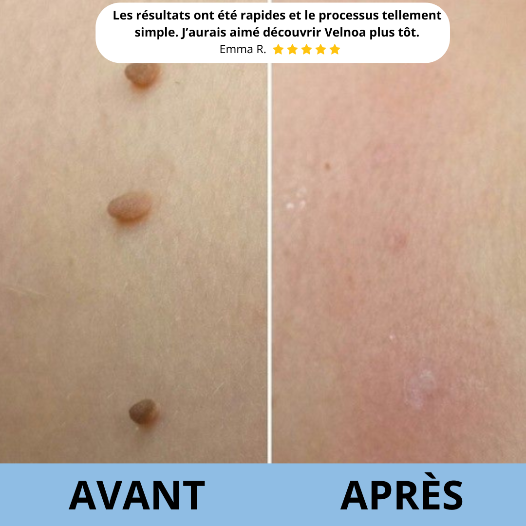 Kit Peau Lisse - Anti-Accrochordons
